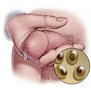 sécrétion de chlamydia